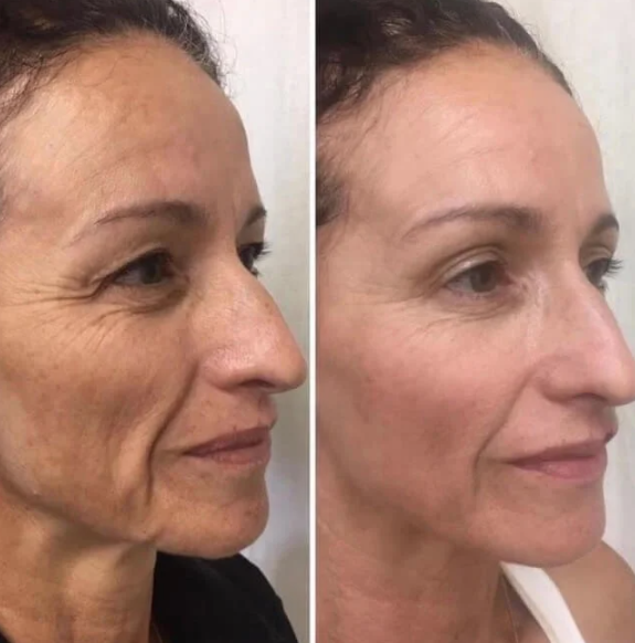 Before and after ProCell Microchanneling treatment results
